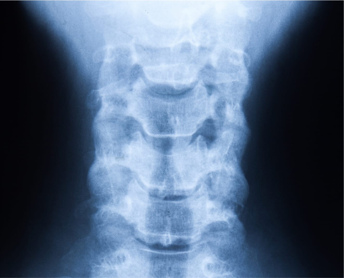 Vertebral Compression Fractures