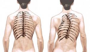 Adolescent Idiopathic Scoliosis