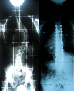 Adolescent Idiopathic Scoliosis