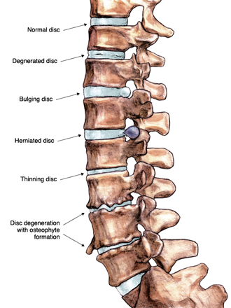 Degenerative Disc Disease Treatment