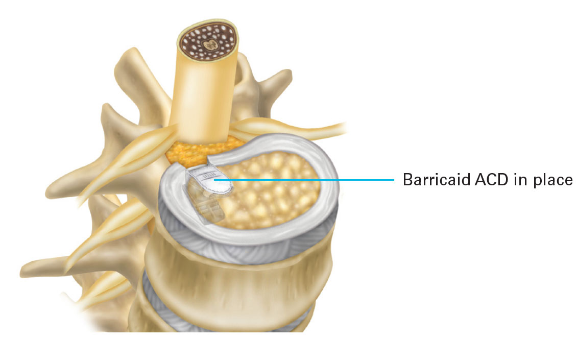 Barricaid ACD in place