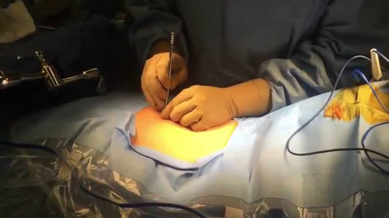 Microdiscectomy