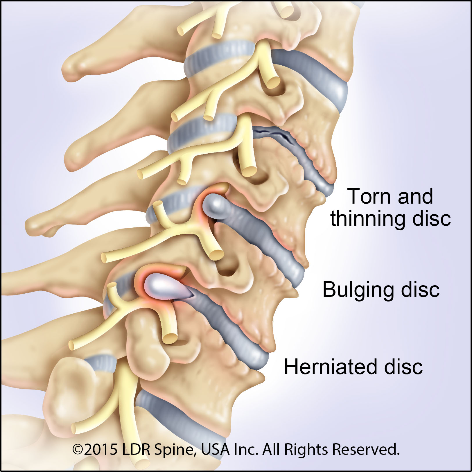 Bulging Disc позвоночника