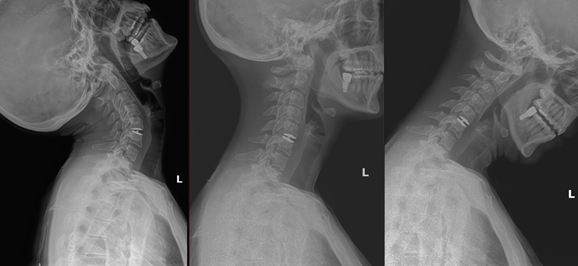 Mobi-C Cervical Disc