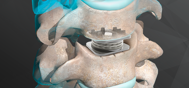 Orthofix M6-C Artificial Cervical Disc