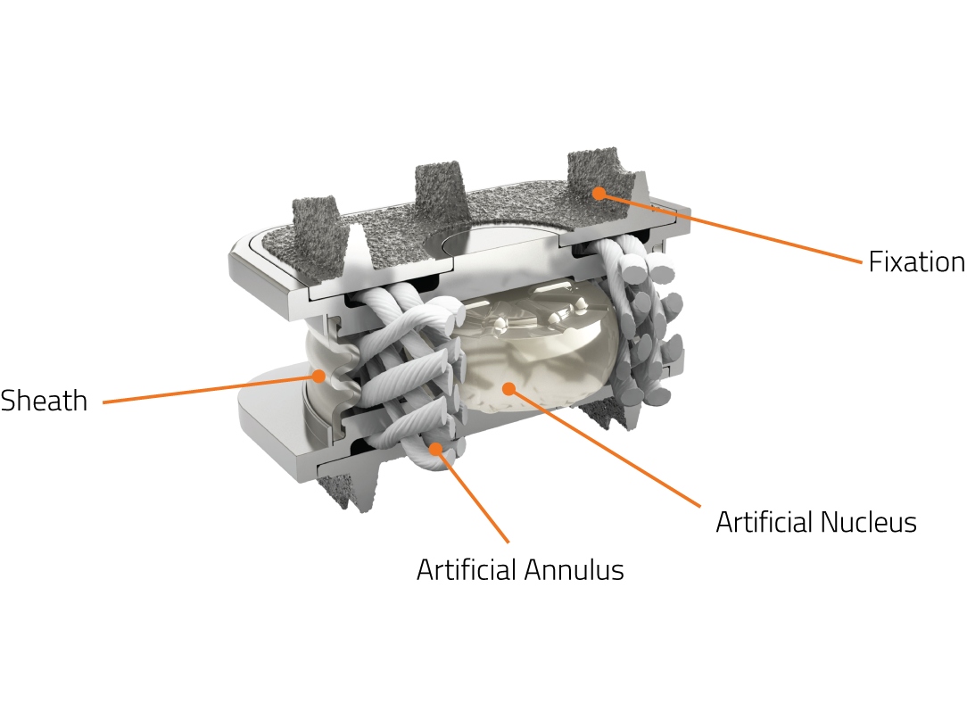 Orthofix M6-C Artificial Cervical Disc