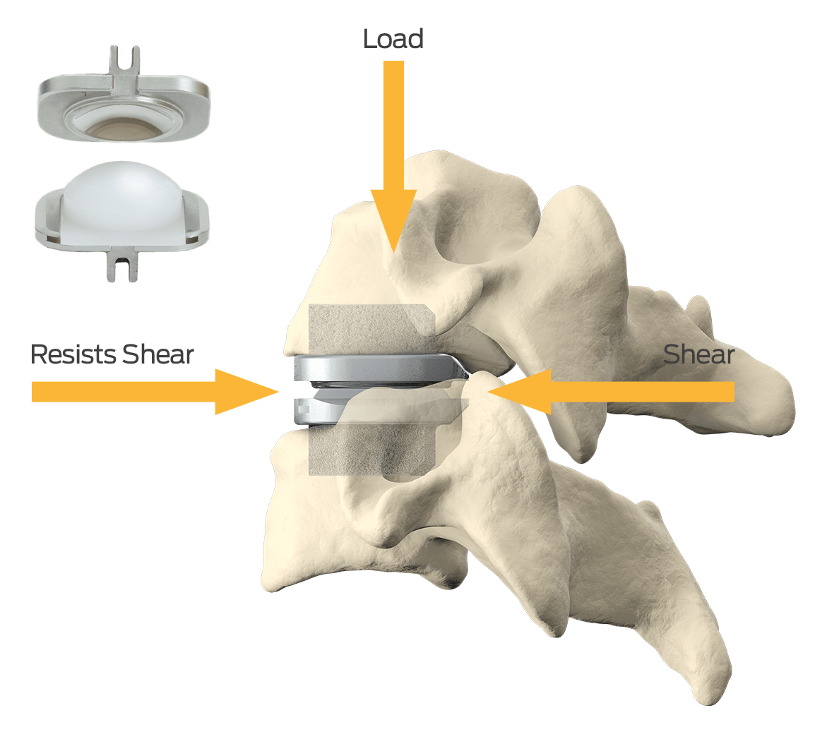 Prodisc-C Forces