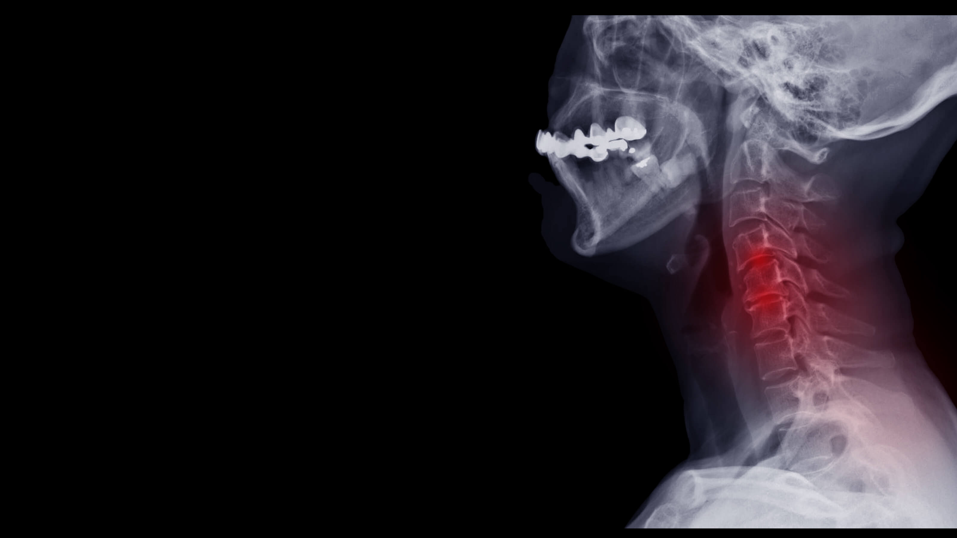 Neck Xray